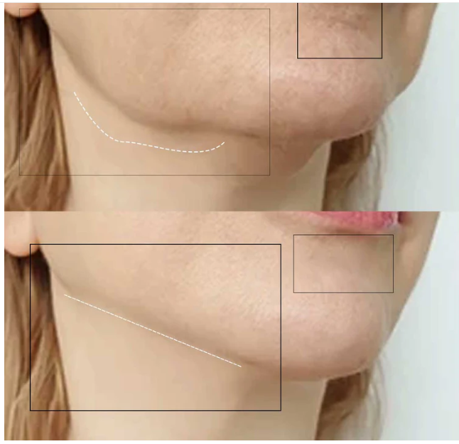 Lumi lift pro
